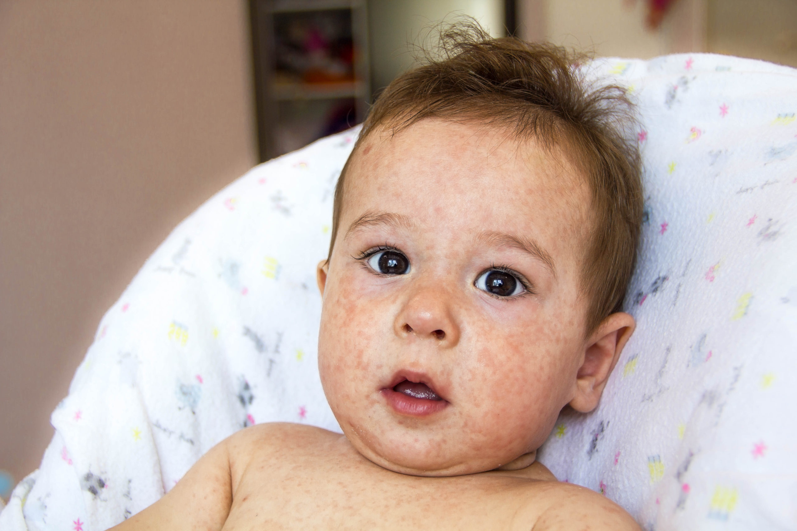 Early Introduction of Peanuts to Reduce Occurrence of Allergies