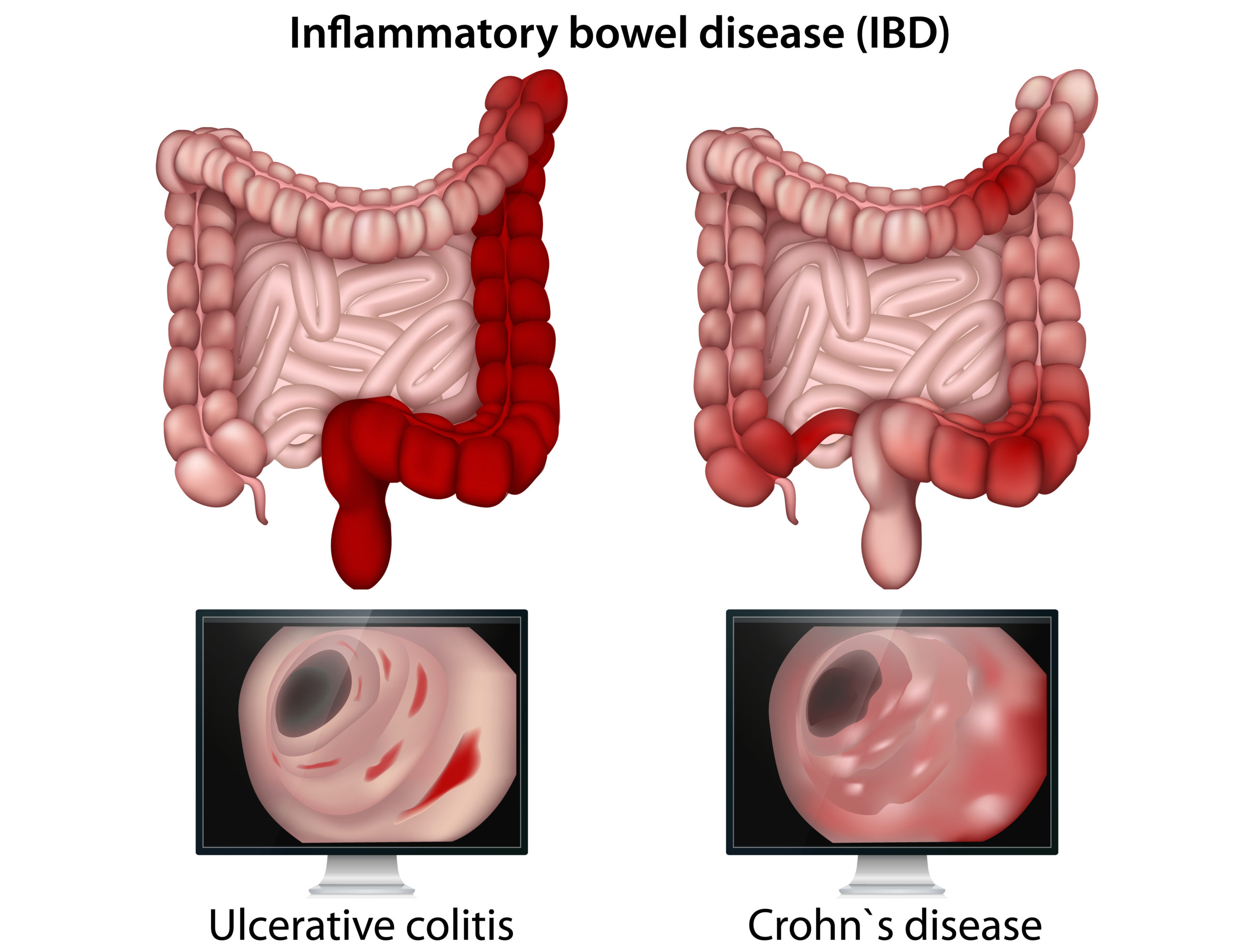 Inflammatory Bowel Disease