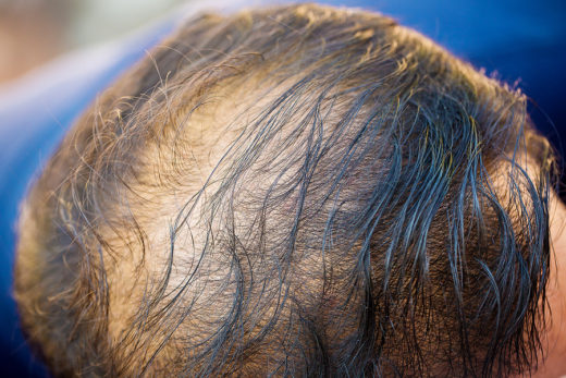 Here Are How Diabetes and Hair Loss Closely Related