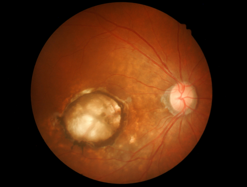 Age-Related Macular Degeneration (AMD)