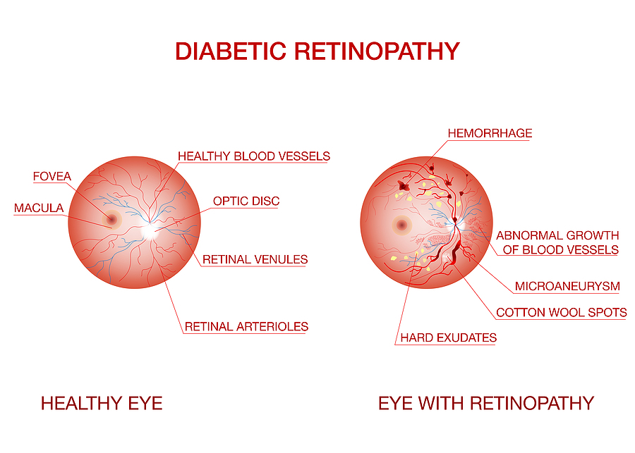 Foods to Prevent Diabetic Retinopathy, Here Are They
