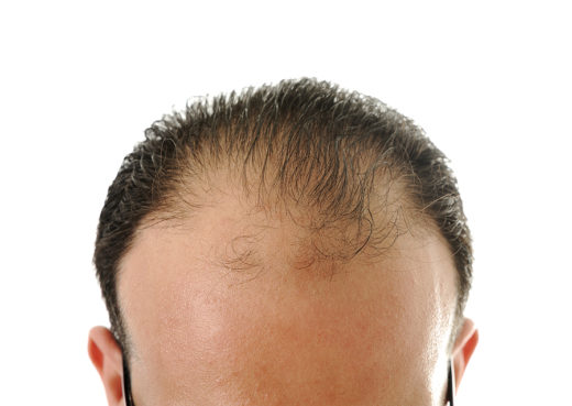 Receding Hairline in Men, Including Its Reasons and Stages