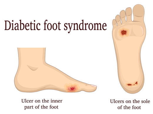 Foot ulcers – a significant problem in diabetes